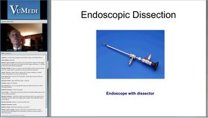 EndoTech® Endoscopic Cubital Tunnel Treatment