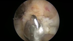 ACL Reconstruction | VuMedi