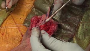Staged Urethroplasty for Penile Urethral Strictures from Lichen Sclerosus and Failed Hypospadias Repair | Vumedi