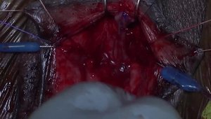 Female Urethroplasty for Urethral Stricture (Dorsal Onlay Buccal Mucosa Graft) | VuMedi