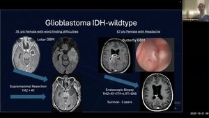 CNS 2025 Insights: Brain Tumor WHO Classification: What Should ...