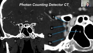 Photon Counting Detector CT for Pituitary Imaging | Vumedi