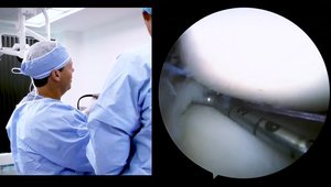 SpeedRoot™ Meniscal Root Repair featuring TRUESPAN™ Meniscal Repair ...