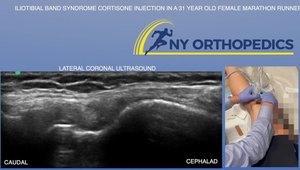 bpc 157 for it band syndrome Iliotibial Band Syndrome Cortisone Injection in a 31 Year Old Female  Marathon Runner
