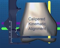 The TEN COMMANDMENTS of Calipered Kinematically Aligned Total Knee Arthroplasty