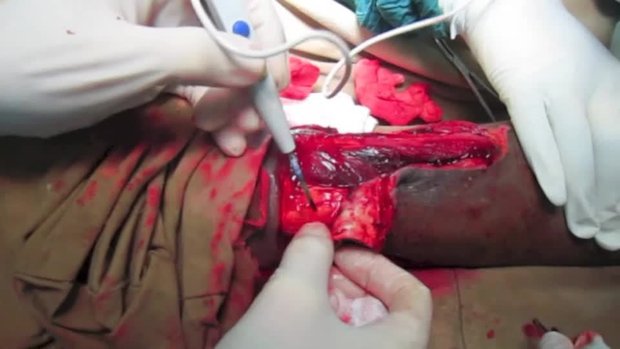 Fasciocutaneous Flap for Bone Coverage of an Open 3B Tibia Fracture ...