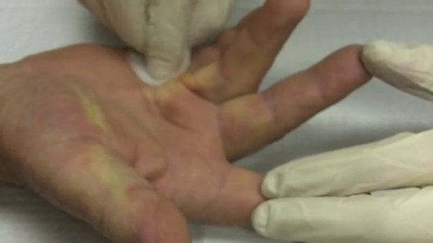 Collagenase injection for Dupuytren's Finger Contracture | Vumedi
