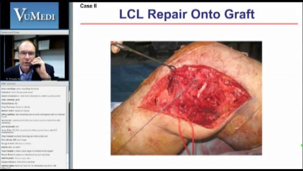 PLC Injuries: Repair & Reconstruction for Acute & Chronic Injuries | Vumedi