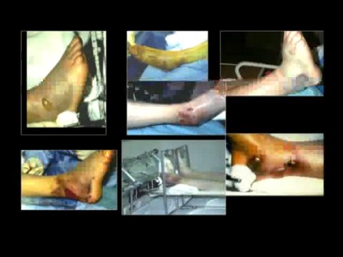 Managing Pilon Fractures | Vumedi