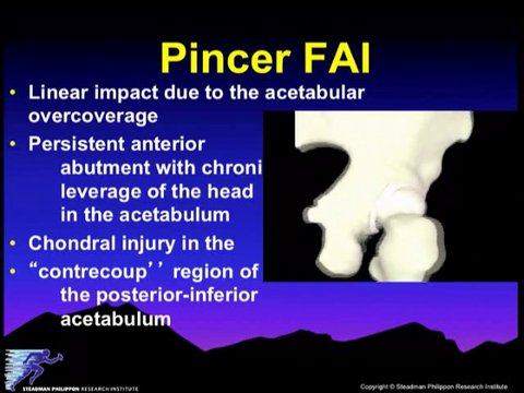 FAI - Overview and Indications for Treatment | Vumedi