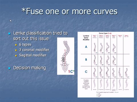 Lenke classification and selection of fusion levels | Vumedi