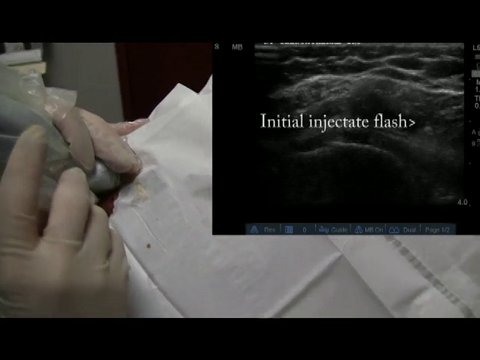 Ultrasound Guided Glenohumeral Injection | Vumedi
