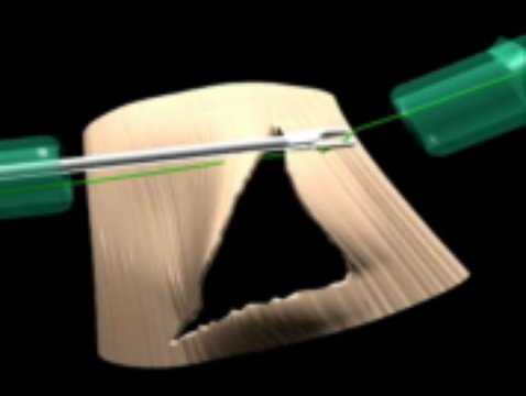 Arthroscopic Rotator Cuff Repair Animation Clips (no audio) | Vumedi