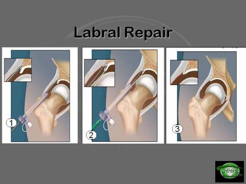 Labral Tears | Vumedi
