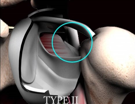 Subscapularis Tears - Classification and Arthroscopic Repair | Vumedi