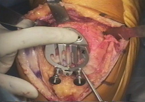Patellofemoral Arthroplasty | Vumedi
