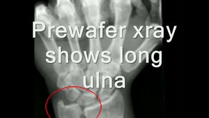 Treatment of Ulnar Wrist Pain with Arthroscopic Wafer Resection (No ...
