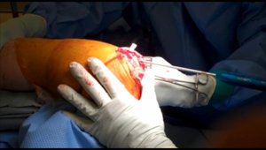 Shoulder Tendon Repair Special Procedure - Steven Chudik MD