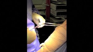 Rotator cuff repair  Kemble Wang Orthopaedics