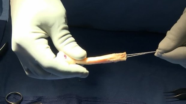 Double Bundle PCL Reconstruction with the Open Tibial Inlay Technique ...