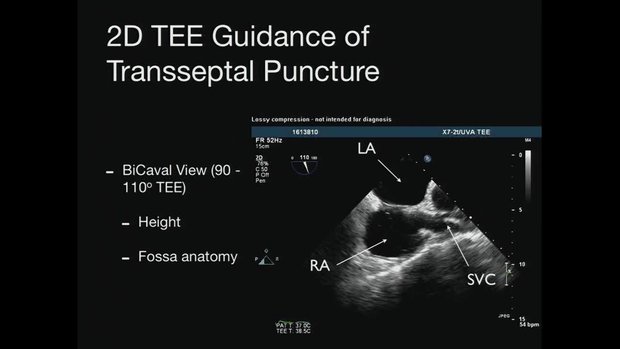 How to do a Transseptal Puncture: easy and safe | Vumedi