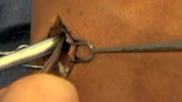 Two Incision Distal Biceps Repair | Vumedi