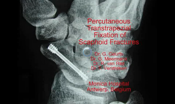 Percutaneous Transtrapezial Fixation of Scaphoid Fractures | Vumedi