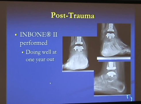 INBONE II Total Ankle System | Vumedi