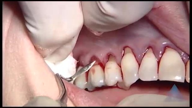 C1-8 AlloDerm Grafting of Multiple Maxillary Teeth with Root Notching ...