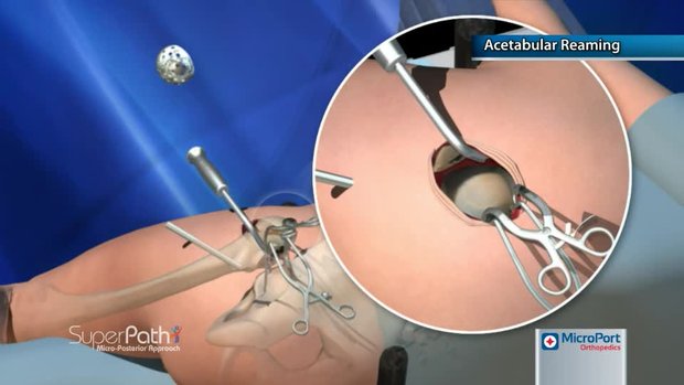 Acetabular Reaming | Vumedi