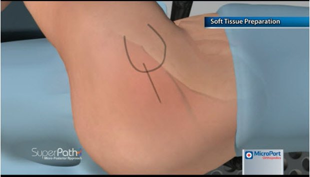 Soft Tissue Preparation | Vumedi