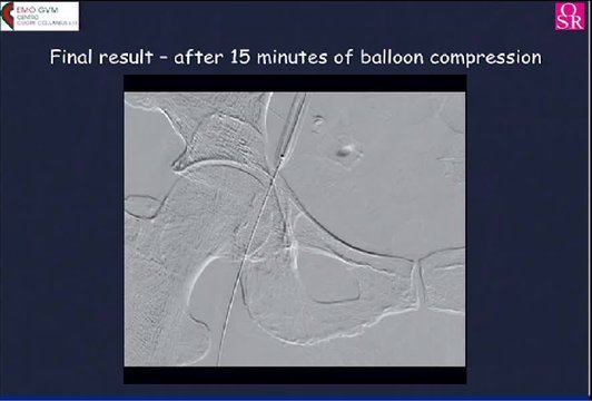 Perclose ProGlide Suture-Mediated Closure System Failure | Vumedi