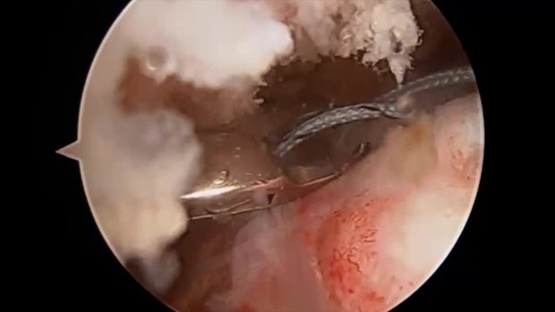 Arthroscopic Revision Rotator Cuff Repair with Dermal Patch ...