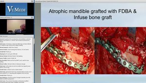 The Effective Use of Recombinant Bone Morphogenic Protein (rhBMP) in Oral Surgery Webinar