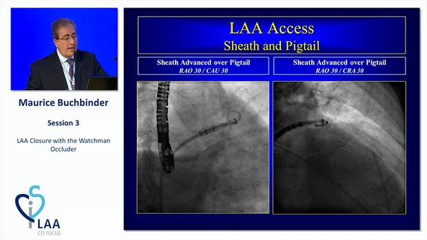 Technique of LAA Closure: Step-by-Step | Vumedi