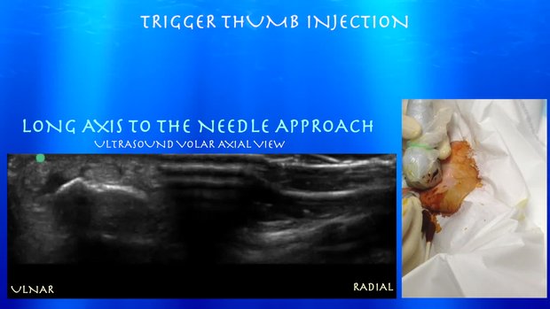 Ultrasound for Trigger Thumb Injection | Vumedi