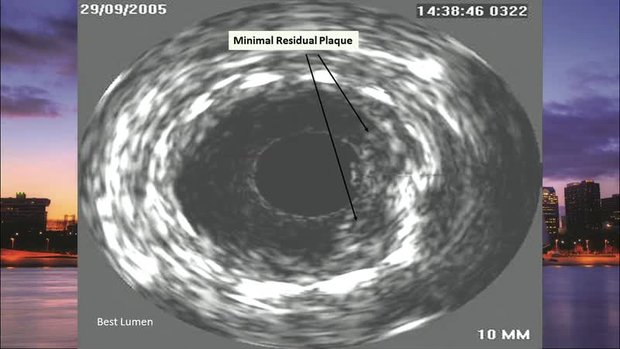 Best Strategy is Still Out There: Bioresorbable Vascular Scaffold (BVS ...