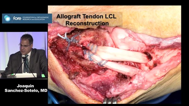 Elbow Reconstruction: PLRI and Tennis Elbow: An Update | Vumedi