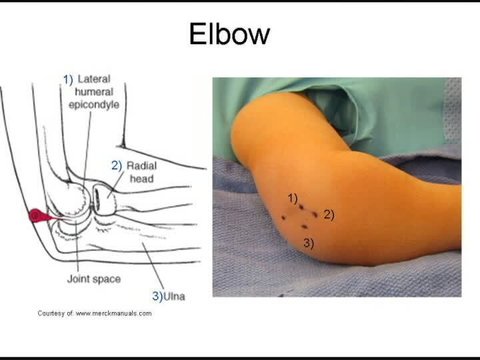Use of Arthrograms in Pediatric Orthopaedic Surgery | Vumedi