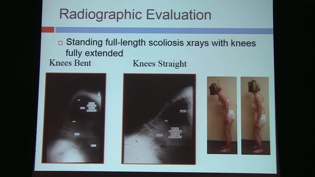 Lumbar Flatback: Etiology, Radiographic Evaluation and Operative ...