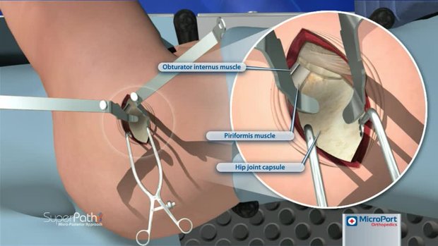 SuperPath® Surgical Technique Animation | Vumedi