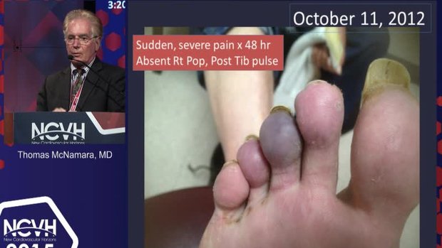 Blue Toe Syndrome: Symptoms, Causes and Treatments | Vumedi