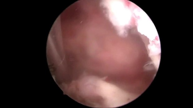 Single Bundle PCL Reconstruction with Hamstring Graft | Vumedi