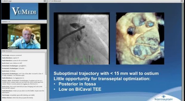 Watchman Deployment in Complex Left Atrial Appendage Anatomy | Vumedi