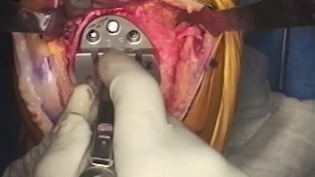Gender Solutions PFJ Surgical Technique | Vumedi