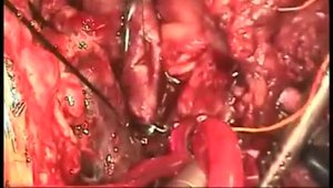 Insertion of an RVAD (Right Ventricular Assist Device) | Vumedi
