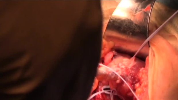 Distal Biceps Tendon Reconstruction - 2 Incision Technique | Vumedi