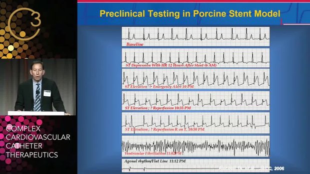 Intracardiac Ischemia Monitoring | Vumedi