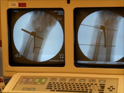 DRUJ Replacement with Scheker Prosthesis | Vumedi