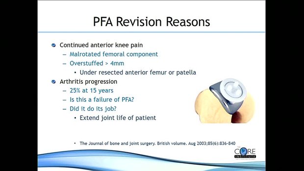 Patellofemoral Arthroplasty: My Experience and Technical Pearls | Vumedi